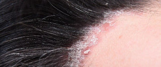 Psoriasis